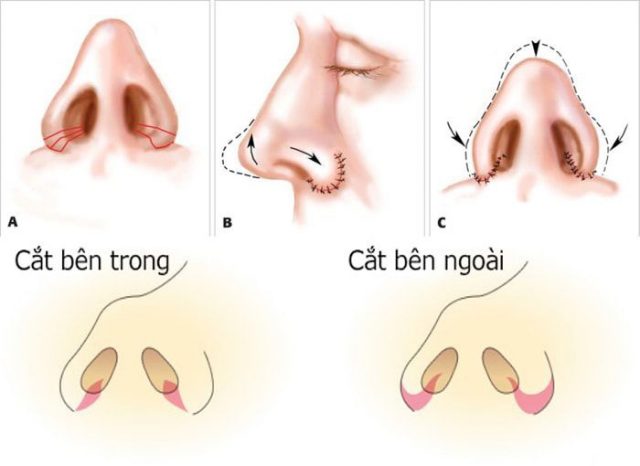 Phương pháp thu gọn cánh mũi giúp mũi trông thon gọn hơn